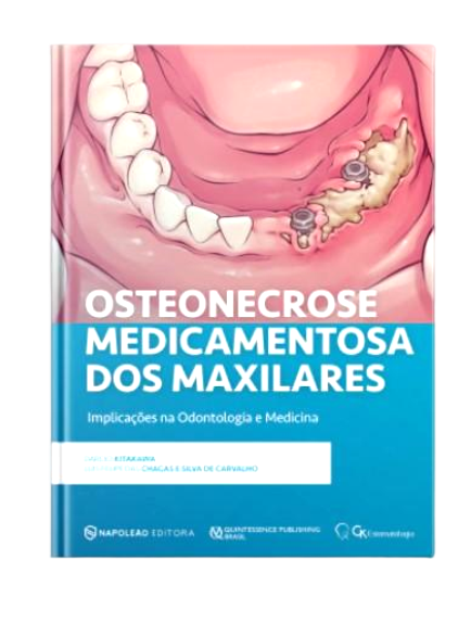 Tudo sobre Osteonecrose Medicamentosa dos maxilares
